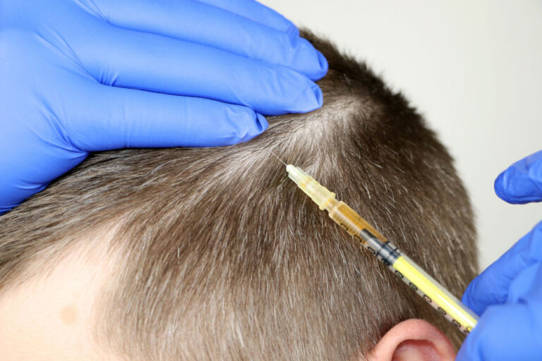 Hair Mesotherapy Or Hair Transplant: A Beautician Doctor Makes I